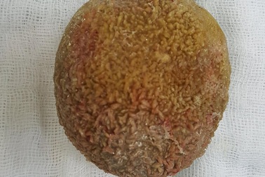 Tiểu khó, buốt vì mang viên sỏi bàng quang nặng nửa cân