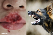 Kẹt chân vào bánh xe, chó cắn nát mặt và những hiểm họa tấn công trẻ mùa hè