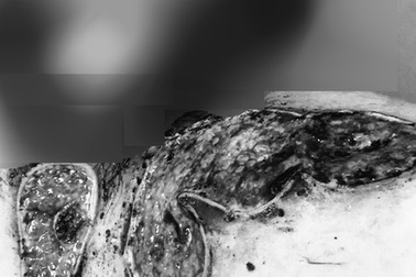 “Chỗ ấy” bốc mùi vì đắp lá chữa bỏng