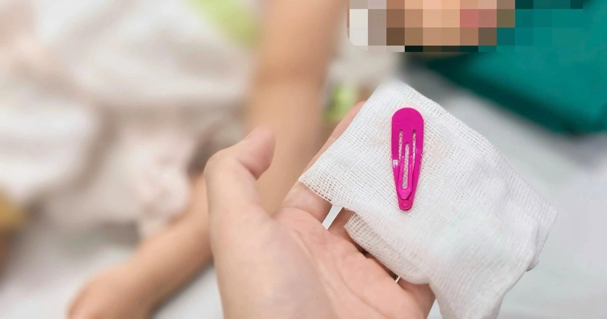 Hà Nội: Bé gái 21 tháng tuổi nuốt kẹp tóc vào bụng