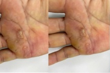 Nhiều bệnh nhân nấm, viêm da, bỏng... đến viện sau bão lũ