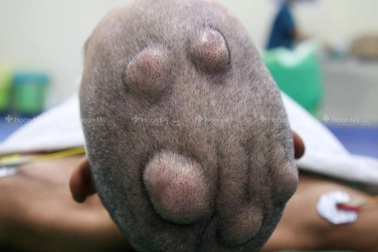 Kỳ lạ người đàn ông mọc chi chít hàng chục khối u trong 12 năm