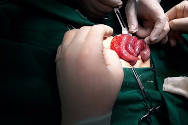 Bé sơ sinh 6 ngày tuổi được phát hiện xoắn ruột vì nôn trớ nhiều, đi ngoài ra máu