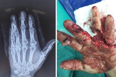 Chủ quan, nam giới suýt mất các ngón tay vì cưa máy