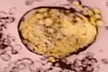 Phương pháp điều trị mới lấy cảm hứng từ người khỏi AIDS đầu tiên