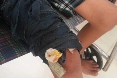 Chuyện lạ, bắt gà cắt tiết rồi buộc vào chân để chữa... gãy xương đùi