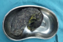 Giật mình phát hiện cả khối tóc đen sì, nặng 5 lạng trong dạ dày bé 7 tuổi