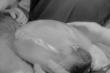 Bé gái chào đời còn nguyên trong bọc ối