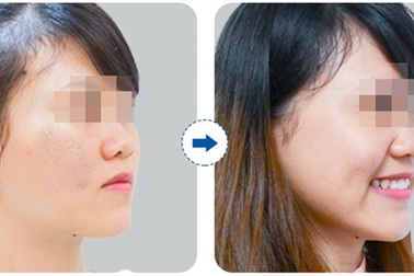 Điều trị sẹo hiệu quả sau 1 liệu trình tại KIM Hospital