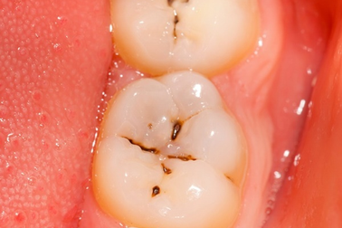 Hôi miệng có nguồn gốc từ đâu?