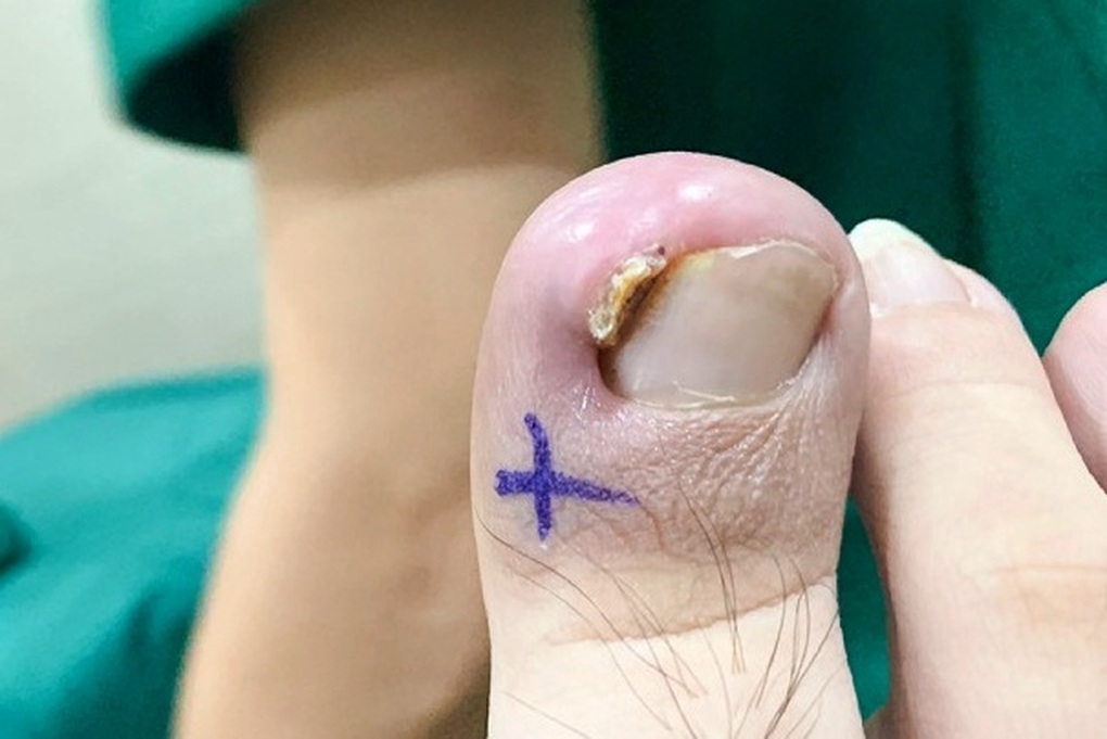 Cắt móng chân sai cách, bé trai ở TPHCM gặp họa - 1 Cắt móng chân sai cách, bé trai ở TPHCM gặp họa - 1