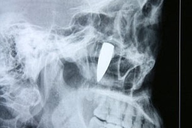 Gắp viên đạn nằm trong gò má 42 năm