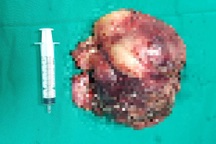 Hà Nội: Khối u to bằng quả bưởi vì "ngại Covid-19" không đi khám