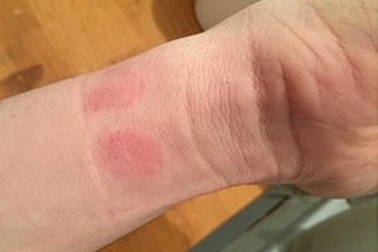 Apple đổ lỗi người dùng đeo Apple Watch không đúng cách khiến da bị tổn thương