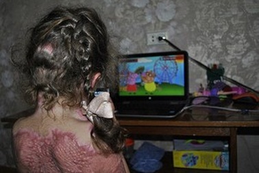 Bé gái 5 tuổi bỏng nghiêm trọng vì làm theo trò lừa lan truyền trên Internet