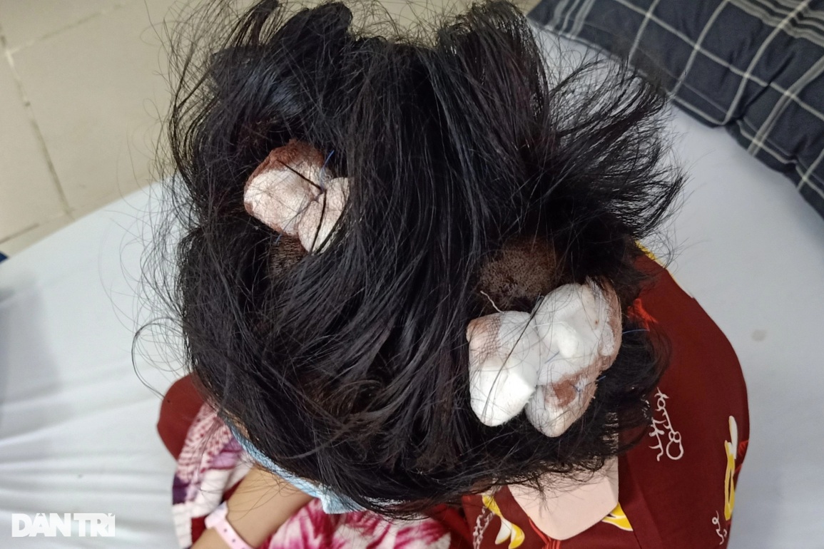Bé gái 16 tuổi bị người tình của mẹ vụt gậy sắt đến bất tỉnh - 1 Bé gái 16 tuổi bị người tình của mẹ vụt gậy sắt đến bất tỉnh - 1