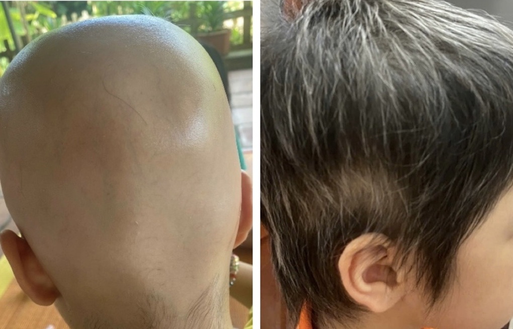 Nhiều người trẻ bỗng dưng rụng tóc trơ trọi - 1