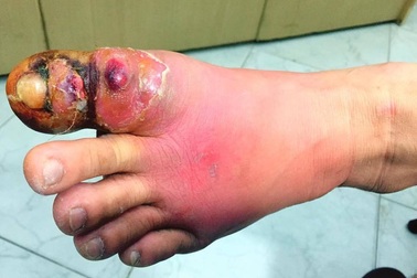 Cắt khóe móng chân tại nhà, một phụ nữ bị hoại tử nhiễm trùng nặng bàn chân