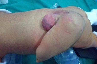 Bé sơ sinh mọc “đuôi” dài 12cm