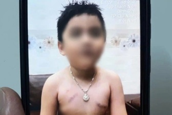 Phụ huynh tố cô giáo "nhéo trẻ bầm ngực", trường nói không có bạo hành