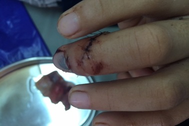 Nối thành công ngón tay bị đứt lìa 