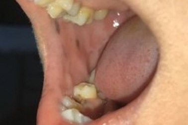Hiếm gặp bệnh mọc nhiều nốt sắc tố trong miệng