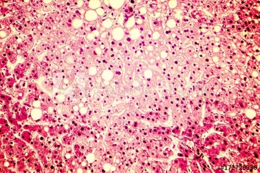 Nấm men đường ruột có thể góp phần gây ra bệnh gan ở một số người