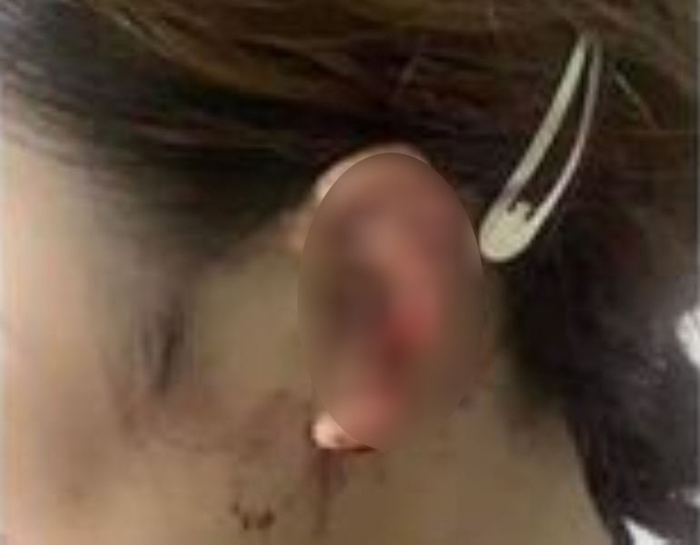 Vụ người phụ nữ đạp vỡ kính ô tô: Cô gái 18 tuổi bị cắn rách tai? - 2 Vụ người phụ nữ đạp vỡ kính ô tô: Cô gái 18 tuổi bị cắn rách tai? - 2