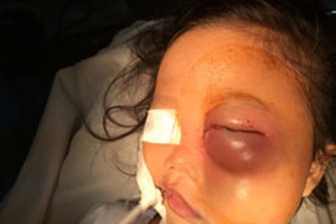 Bé 4 tuổi bị khỉ cắn trọng thương