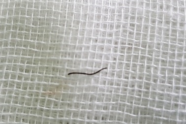 Người đàn ông 46 tuổi bị mảnh sắt đâm xuyên giác mạc