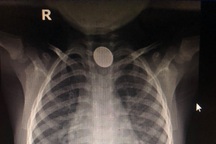 Bé trai bị hóa chất ăn mòn thực quản vì nuốt cục pin