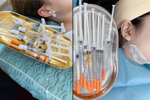 Thâm nhập spa chui: Tiêm filler tại phòng khách, cam kết miệng