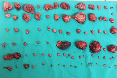 Hi hữu người đàn ông mang hàng trăm khối u trong cơ thể