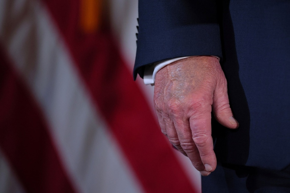 Tổng thống Trump bị suy tĩnh mạch: Nhiều người Việt mắc, có nguy hiểm? - 1 Tổng thống Trump bị suy tĩnh mạch: Nhiều người Việt mắc, có nguy hiểm? - 1