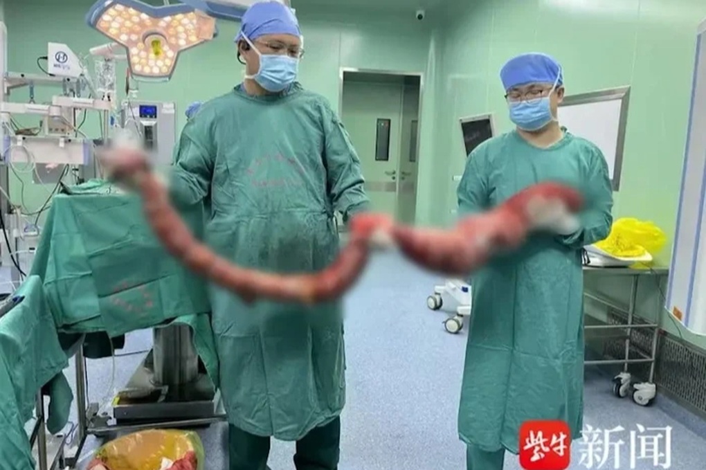 Un homme a subi une intervention chirurgicale pour retirer 20 kg de masse intestinale après ne pas avoir déféqué pendant 4 mois - 1 Không đại tiện 4 tháng, người đàn ông được mổ lấy khối ruột nặng 20kg - 1