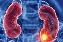 Ung thư thận có chữa được không?