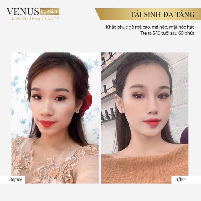 Trẻ ra 10 tuổi xuân chỉ sau 60 phút bằng Tái sinh đa tầng tại Venus by Asian. - Ảnh 4.