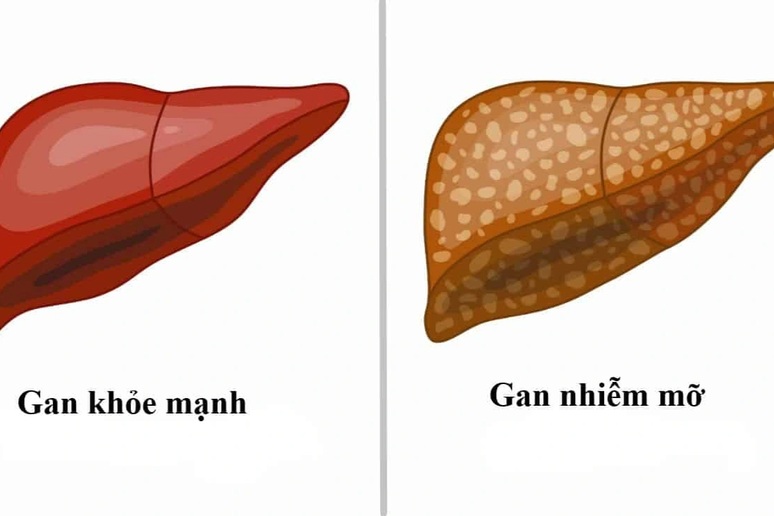 Gan nhiễm mỡ có dẫn đến ung thư gan?