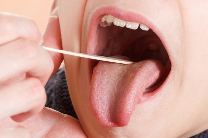 Viêm amidan là một bệnh tai mũi họng phổ biến ở trẻ nhỏ. Ảnh minh họa.
