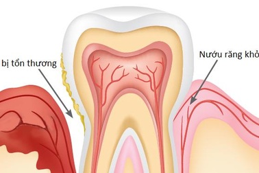 Bệnh nha chu – biến chứng răng miệng ở người đái tháo đường