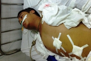 Bị viêm túi mật, mổ cấp cứu ruột thừa