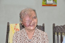 Người đàn bà có khối u khổng lồ bước đầu phẫu thuật thành công