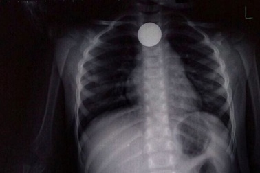 Bình Định: Gắp dị vật đồng xu kẹt trong thực quản bé 3 tuổi