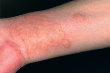 Đề phòng chứng mề đay do giá rét