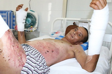 Cha nguy kịch vì bỏng điện, bầy con thơ đói khát