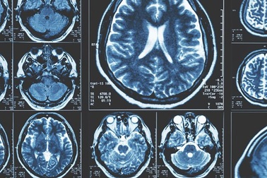 Các nhà nghiên cứu phát hiện ra những dấu hiệu sớm nhất của bệnh Parkinson trong não
