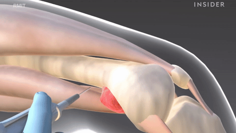 Công nghệ “Xương in 3D”: Giải pháp đột phá trong điều trị gãy xương, ung thư - 2 Công nghệ “Xương in 3D”: Giải pháp đột phá trong điều trị gãy xương, ung thư - 2