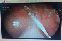 Quảng Bình: Ăn kẹo mút, bé trai 2 tuổi nuốt luôn que nhựa 5cm vào bụng