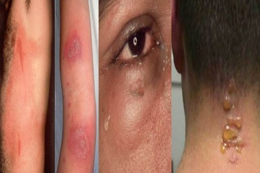 Vào mùa kiến ba khoang tăng vọt bệnh nhân đến khám vì viêm da tiếp xúc