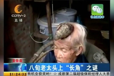 Cụ bà mọc “sừng” dài 13cm trên đầu